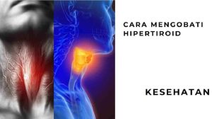 Cara Mengobati Hipertiroid