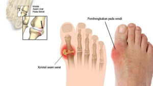 Cara penanganan asam urat agar tidak kambuh