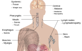 AIDS penyakit mematikan nomor 1