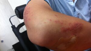 Pengobatan memar secara alami