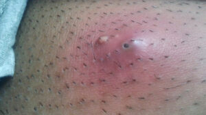 Cara Mengobati bisul dengan minyak tawon