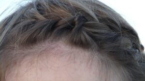 mengatasi ketombe dengan bahan alami