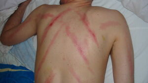 Fakta tentang kerokan