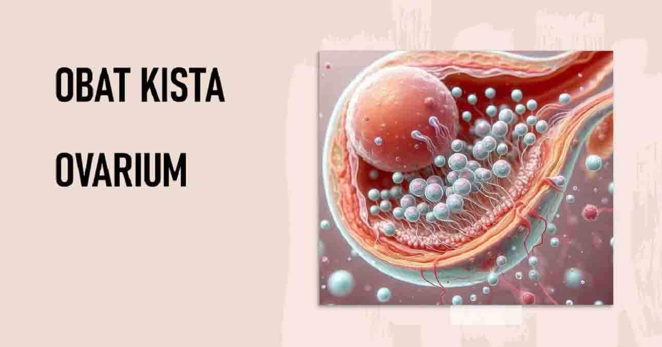 Obat Kista Ovarium: Temukan Cara Ampuh Mengatasi Kista Ovarium