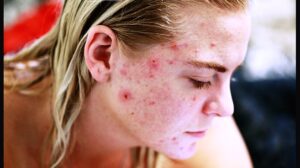 Penghilang bekas jerawat