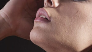 Minyak tawon untuk bopeng