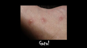 Minyak Tawon untuk Gatal